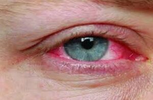 Eye Flu: पासुन स्वतःचा बचाव कसा करावा