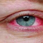 Eye Flu: पासुन स्वतःचा बचाव कसा करावा